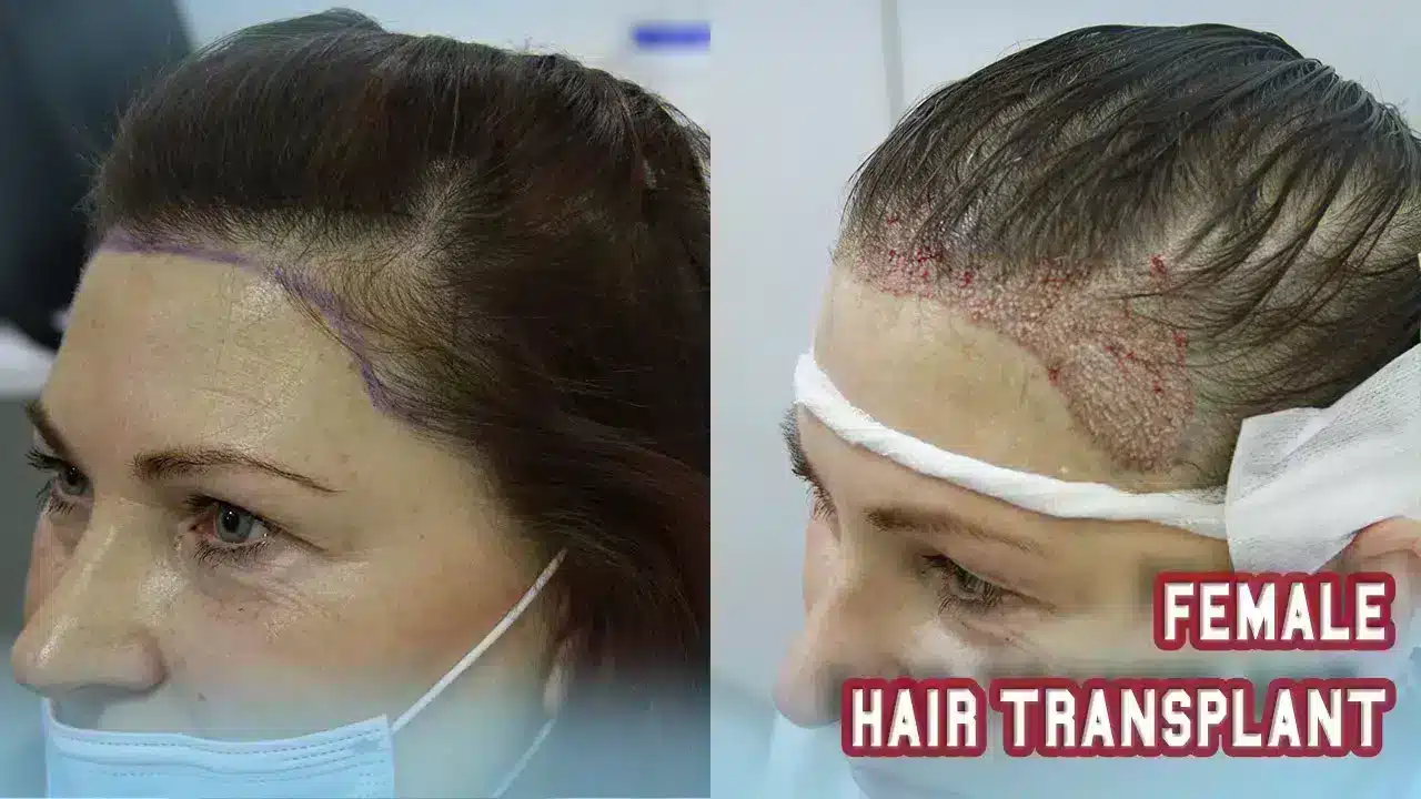 female hair transplant