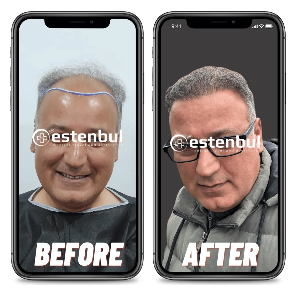 Fue Hair Transplant Results