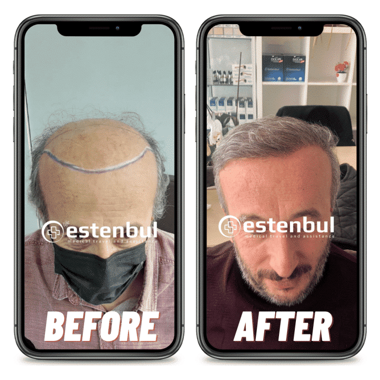 Hair Transplant Results Before And After Pictures Of Real Patients Estenbul Health