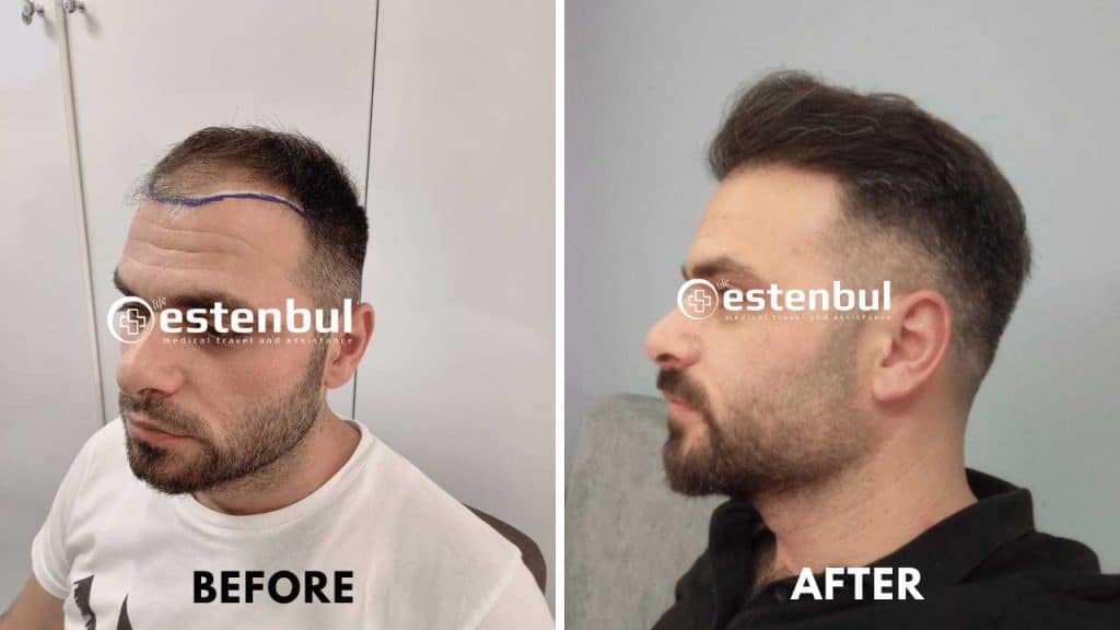 Natural Results for Hair Transplant
