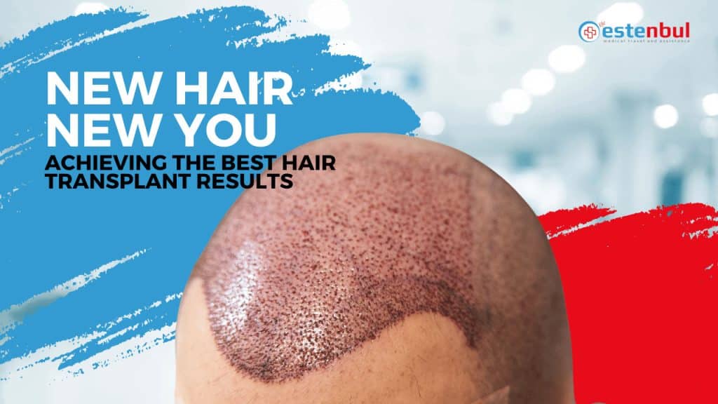 New Hair New You: Achieving the Best Hair Transplant Results
