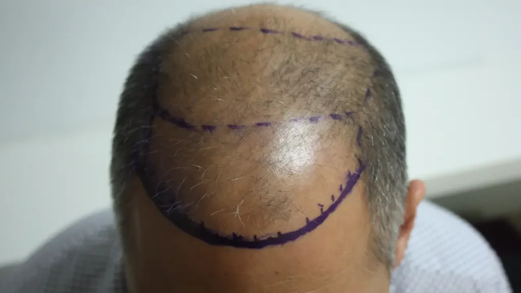 Are You a Good Candidate for a Hair Transplant in Turkey?