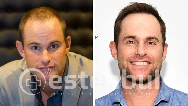 Andy Roddick Hair Transplant