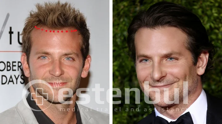 Bradley Cooper Hair Transplant