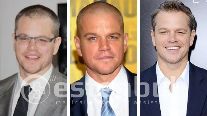 Matt Damon Hair Loss