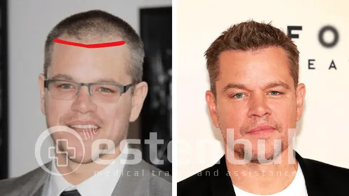 Matt Damon Hair Transplant