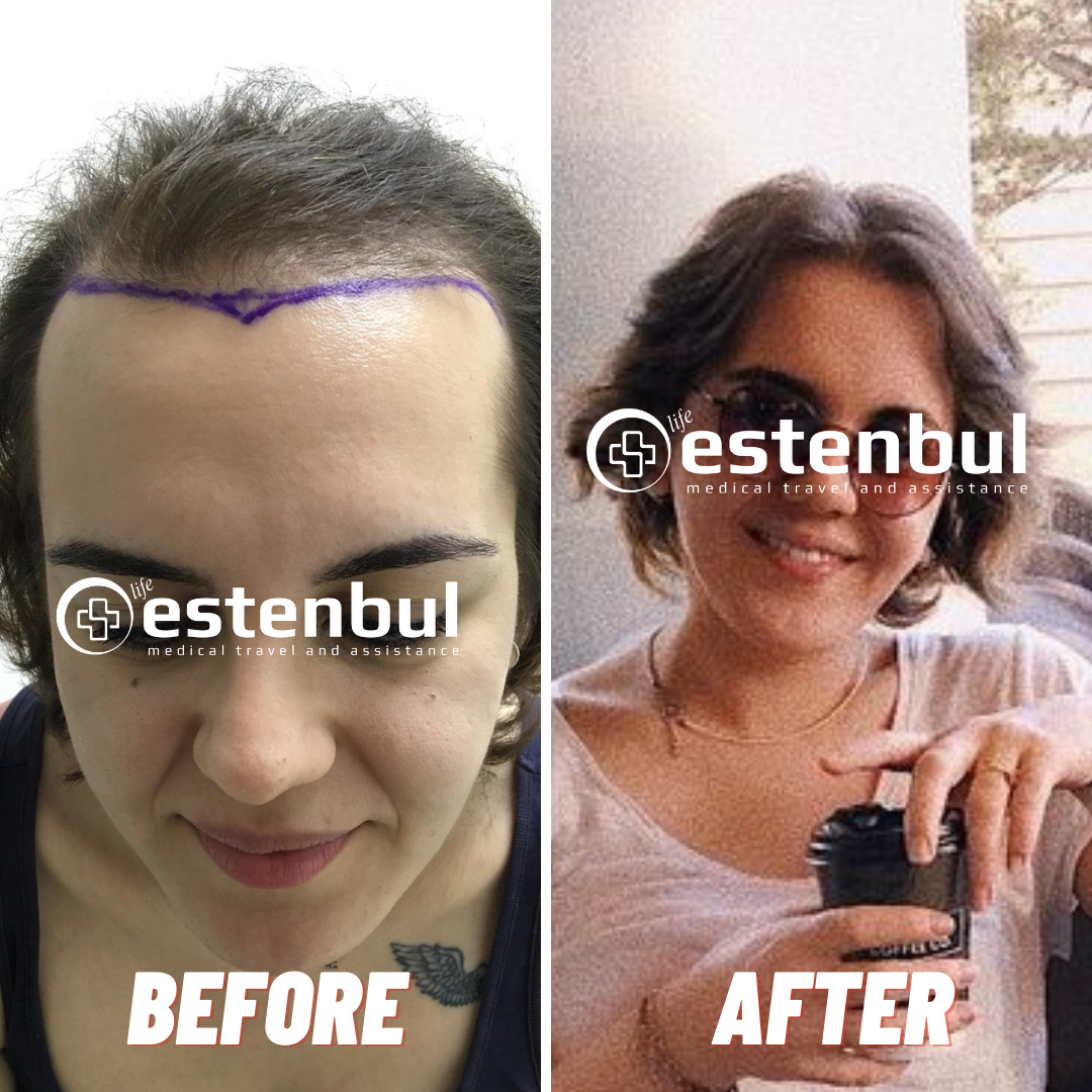 Female Hair Transplant Result