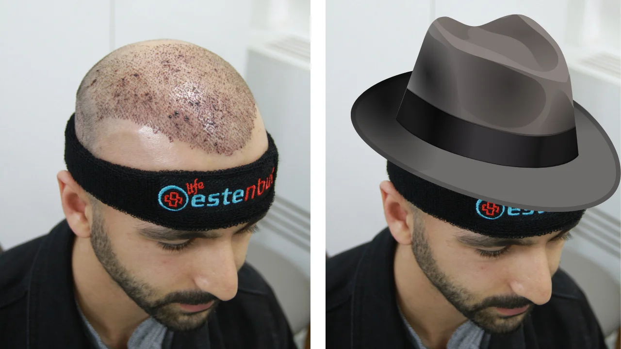 Wear A Hat After Hair Transplant
