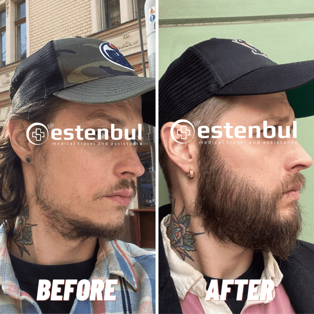 beard transplant in istanbul 2023
