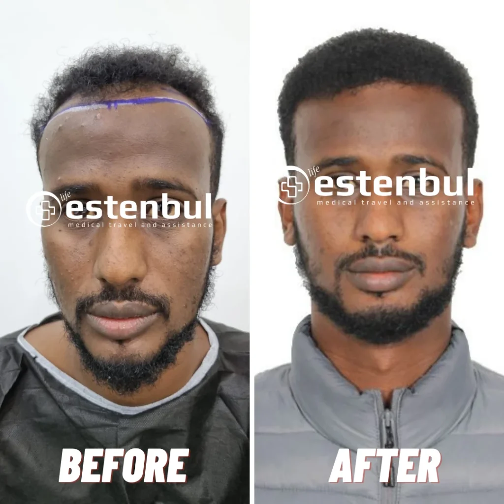 hair transplant before and after 690