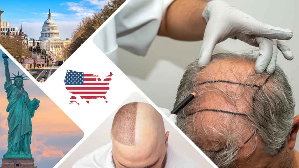 5000 Grafts Hair Transplant Cost USA