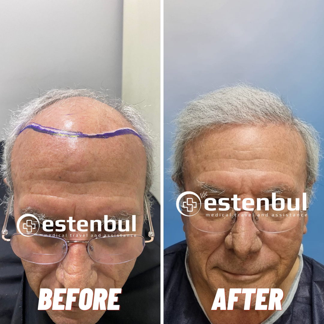 Hair Transplant Turkey Before and After Results
