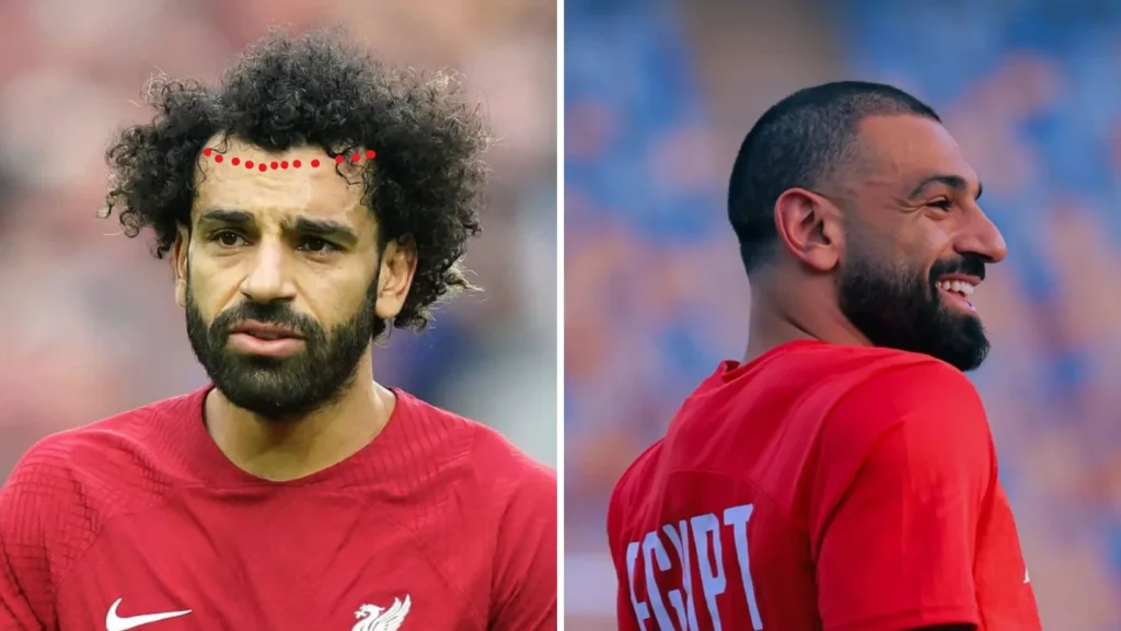 Mohamed Salah's Hair Transplant Surgery