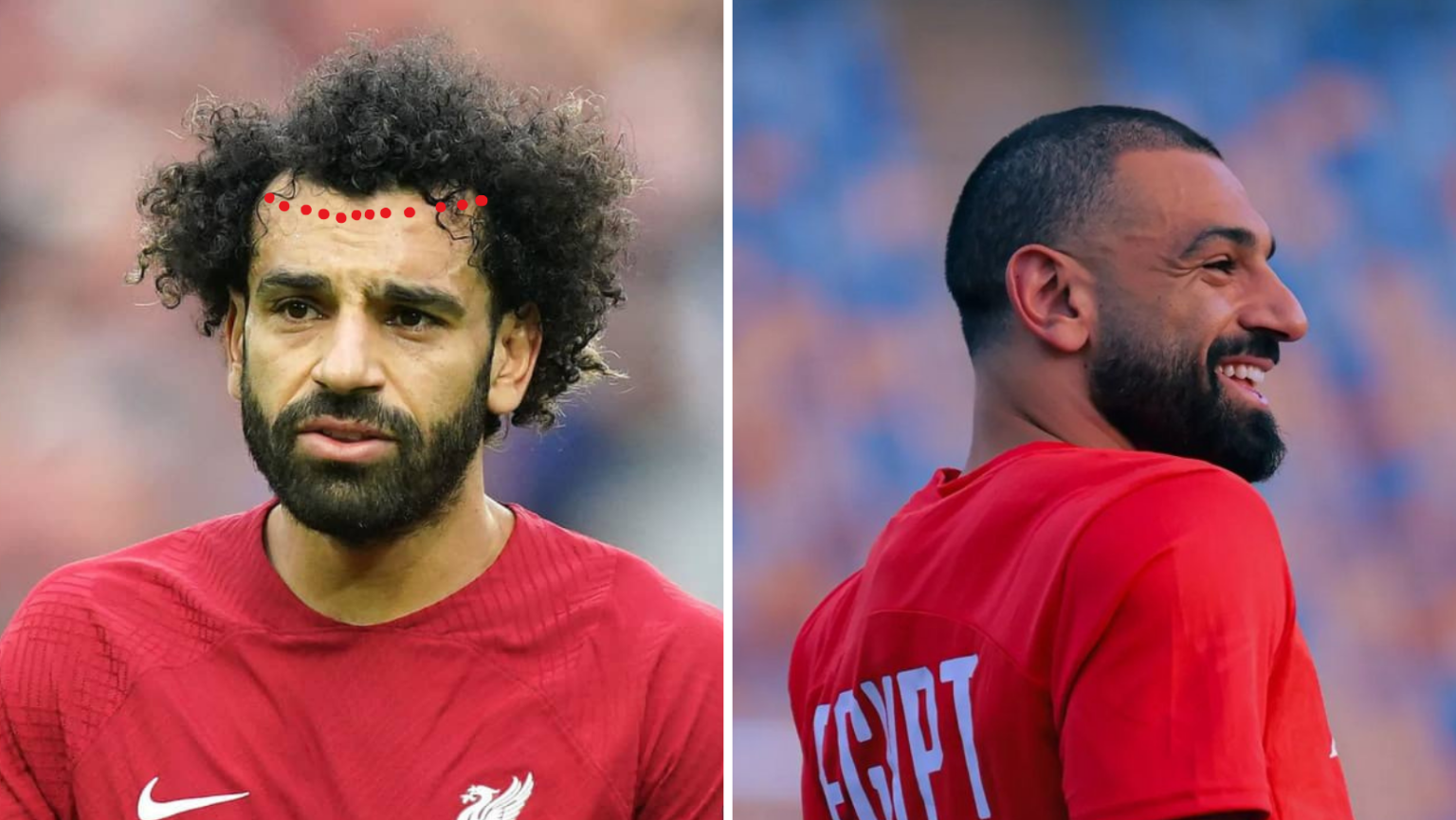 Mohamed Salah Hair Transplant | Estenbul Health