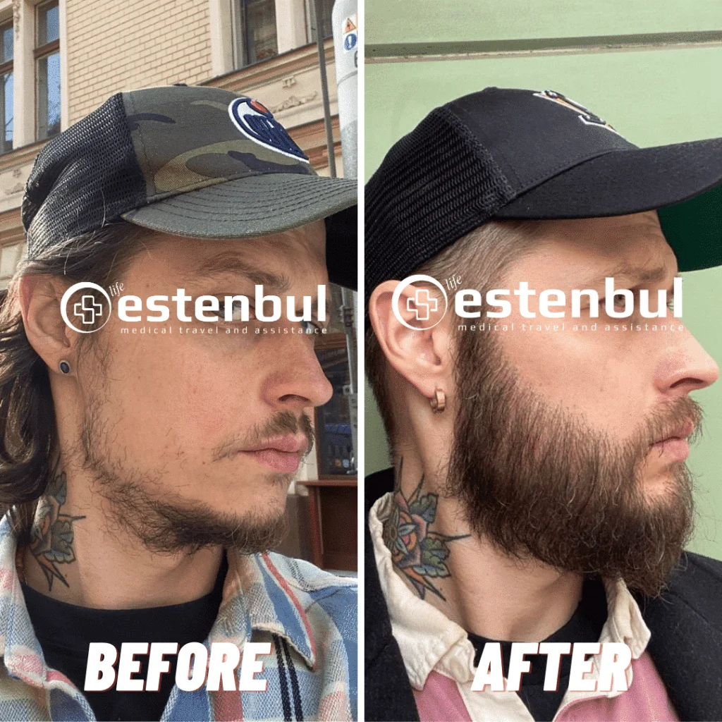 Beard Transplant Before and After