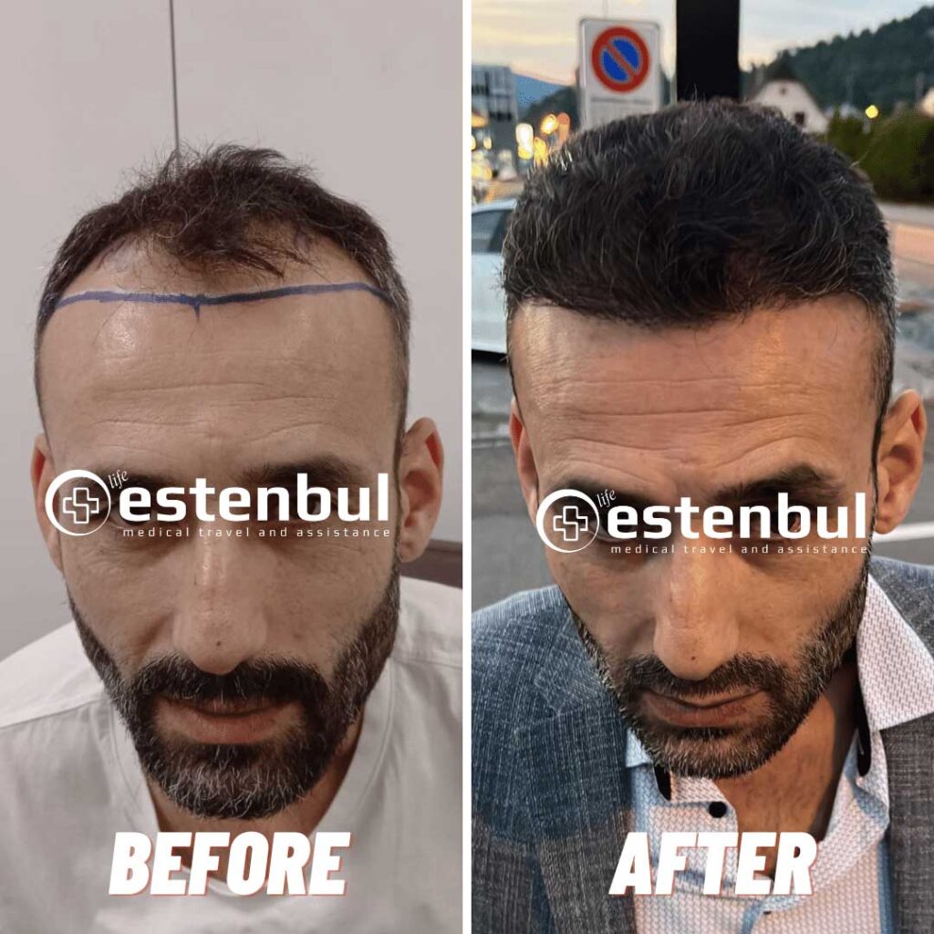 haartransplantation vorher nachher ergebnis