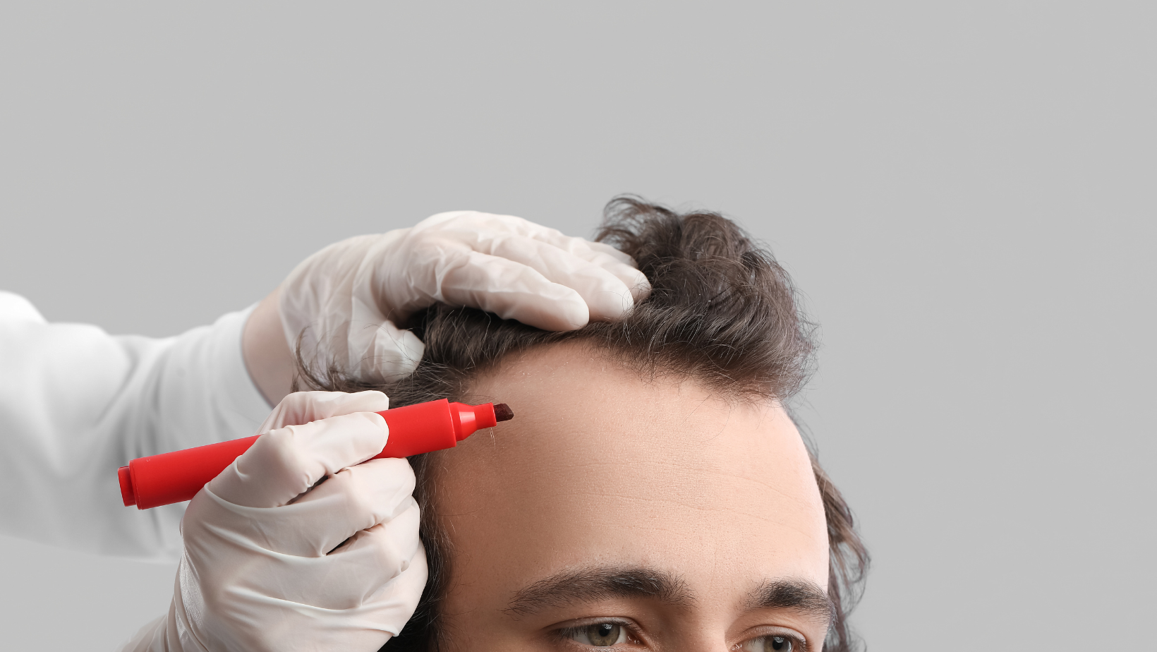 Why Does Your Hair Transplant Look Unnatural? Top 5 Reasons and Solutions for Natural-Looking Results